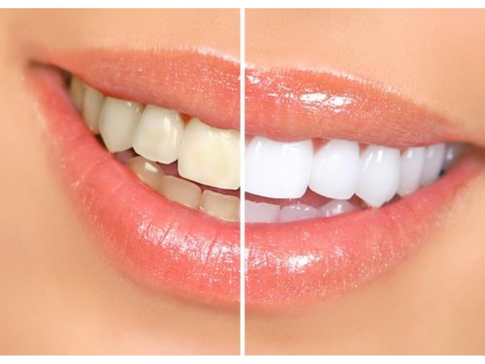 Premium Dental - Clinica de estetica dentara - theeth-whitening-before-and-after.jpg