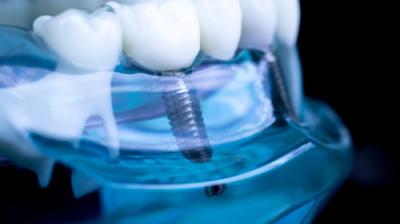 Implanturile Dentare vs. Punțile Dentare: Care Este Cea Mai Bună Opțiune Pentru Tine?