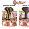 Spina bifida - afectiune congenitala a coloanei vertebrale