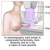 Totul despre mamografie