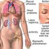 Lupusul eritematos sistemic - boala autoimuna