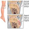 Boala Osgood-Schlatter – o afectiune a tendoanelor genunchiului