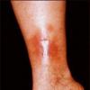 Ulcerul de gamba