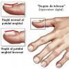 Modificarile patologice ale unghiilor