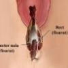 Rupturi la nivelul vaginului in timpul nasterii
