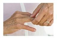 artrita reactiva usmf permanganat de potasiu pentru inflamarea articulațiilor