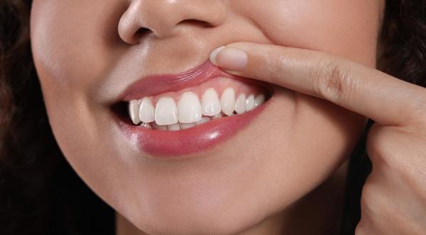Gingivectomia - beneficii estetice si terapeutice Gingivectomia - beneficii estetice si terapeutice