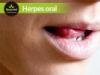 Herpes_oral.jpg