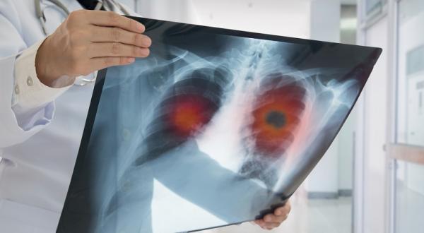 Lobectomia pulmonara - optiune medicala pentru afectiunile pulmonare complexe Lobectomia pulmonara - optiune medicala pentru afectiunile pulmonare complexe