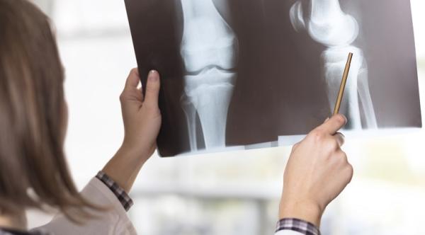 Chistul anevrismal osos - cauze, diagnostic si optiuni terapeutice Chistul anevrismal osos - cauze, diagnostic si optiuni terapeutice