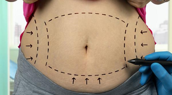 Abdominoplastia, solutia rapida pentru un abdomen atractiv Abdominoplastia, solutia rapida pentru un abdomen atractiv
