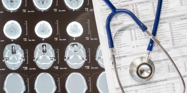 Recunoaste semnele accidentului vascular cerebral Recunoaste semnele accidentului vascular cerebral
