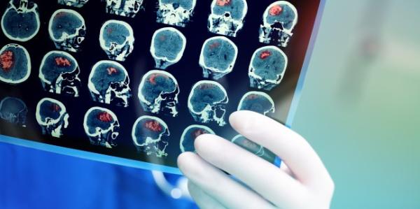 Depistarea primelor semne ale accidentului vascular cerebral Depistarea primelor semne ale accidentului vascular cerebral