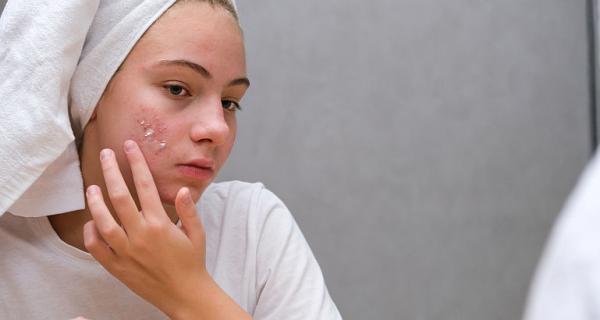 Prevenirea si tratarea tenului acneic la adolescenti Prevenirea si tratarea tenului acneic la adolescenti