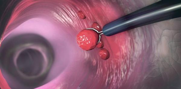 Importanta depistarii precoce a cancerului de colon Importanta depistarii precoce a cancerului de colon