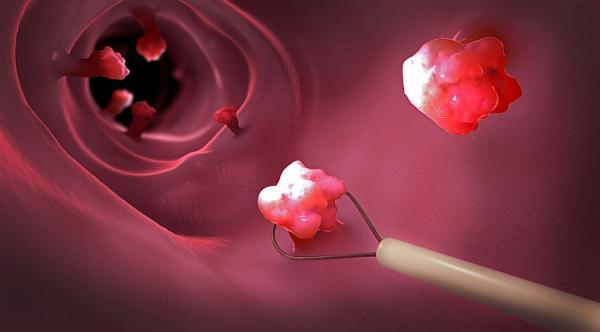 Screeningul cancerului colo-rectal Screeningul cancerului colo-rectal