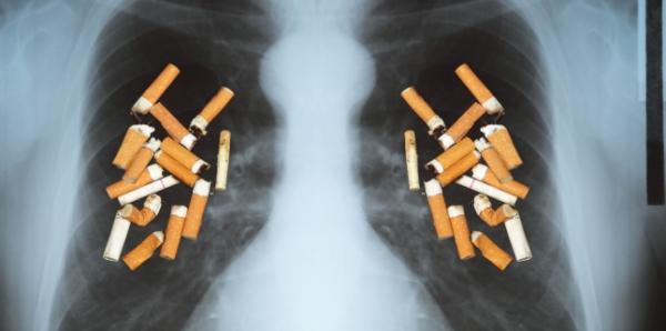 Cancerul pulmonar - cum poti recunoaste din timp simptomele? Cancerul pulmonar - cum poti recunoaste din timp simptomele?