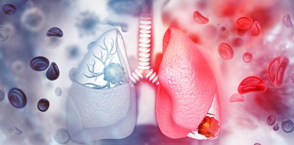 Rolul stilului de viata in aparitia cancerului bronhopulmonar Rolul stilului de viata in aparitia cancerului bronhopulmonar