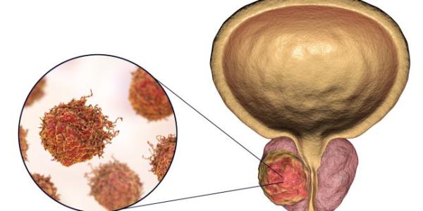 Simptomele precoce ale cancerului de prostata Simptomele precoce ale cancerului de prostata