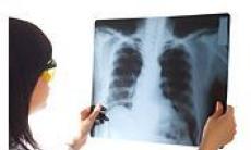 5 cauze ale aparitiei cancerului pulmonar la nefumatori