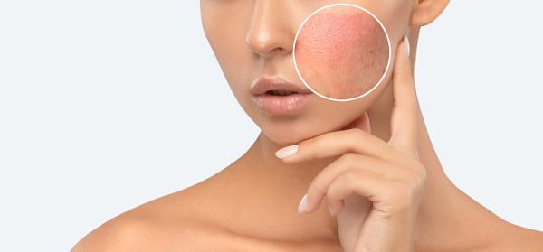 Dermatita periorala: cauzele aparitiei Dermatita periorala: cauzele aparitiei