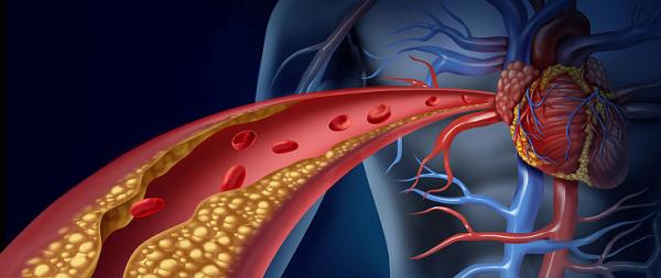 Dislipidemia - un real pericol pentru cardiaci Dislipidemia - un real pericol pentru cardiaci