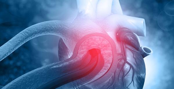 Ectazia de aorta - cauze, simptome si tratament Ectazia de aorta - cauze, simptome si tratament