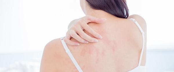Eczema Eczema