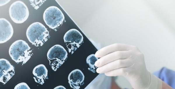 Epilepsia – simptome, cauze si tratament Epilepsia – simptome, cauze si tratament