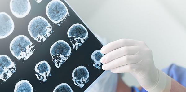 Ce ar trebui sa stii despre epilepsia dobandita in copilarie Ce ar trebui sa stii despre epilepsia dobandita in copilarie