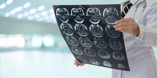 Hemoragia intracraniana Hemoragia intracraniana