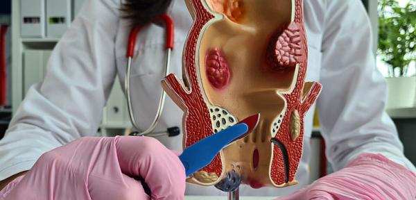 Hemoroizi sau cancer? Hemoroizi sau cancer?