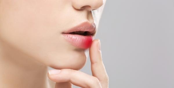 Herpes oral - generalitati Herpes oral - generalitati