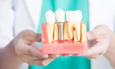 Implanturile dentare - tipuri, avantaje si riscuri