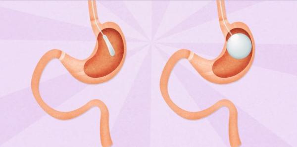 Inelul gastric, solutie impotriva obezitatii Inelul gastric, solutie impotriva obezitatii