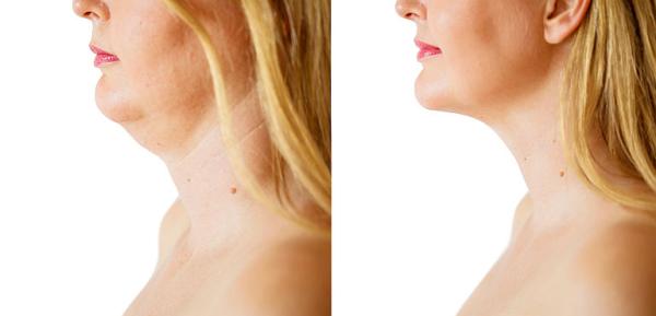 Cervicoplastia - procedura de corectare a aspectului neplacut al zonei gatului Cervicoplastia - procedura de corectare a aspectului neplacut al zonei gatului