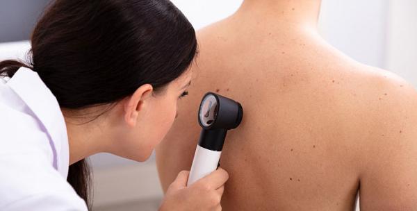 Melanomul poate fi prevenit? Melanomul poate fi prevenit?