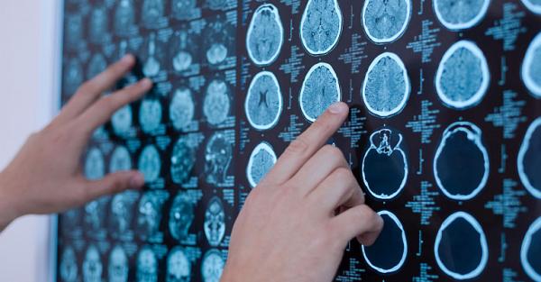Tipuri de neurofibromatoza Tipuri de neurofibromatoza