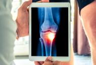 Genunchiul articulației genunchiului Hoff: descriere și tratament