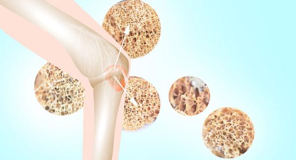 Diagnosticul precoce al osteoporozei Diagnosticul precoce al osteoporozei