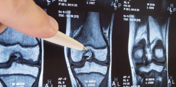 Semnele care va anunta ca suferiti de osteoporoza Semnele care va anunta ca suferiti de osteoporoza