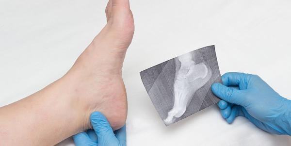 Cand si de ce se dezvolta pintenii ososi(osteofit) Cand si de ce se dezvolta pintenii ososi(osteofit)