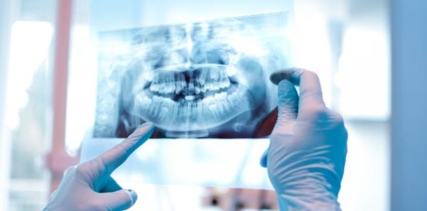 Radiografia dentara poate fi periculoasa? Radiografia dentara poate fi periculoasa?