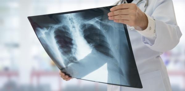 Tuberculoza (TBC): simptome si tratament Tuberculoza (TBC): simptome si tratament