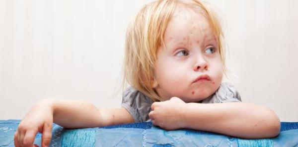 Rujeola - o infectie extrem de contagioasa Rujeola - o infectie extrem de contagioasa