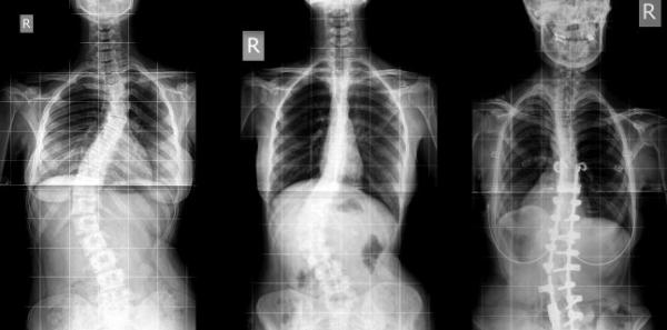 Scolioza - cauze, simptome, tratament Scolioza - cauze, simptome, tratament