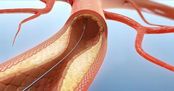 Stenoza aortica Stenoza aortica