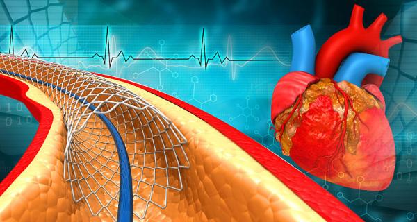 Ce este restenozarea de stent si cum o poti preveni? Ce este restenozarea de stent si cum o poti preveni?