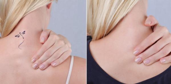Metode de indepartare a tatuajelor Metode de indepartare a tatuajelor