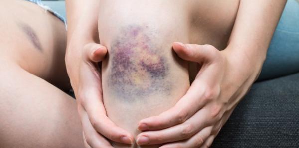 Care este diferenta dintre vanataie si cheag de sange? Care este diferenta dintre vanataie si cheag de sange?